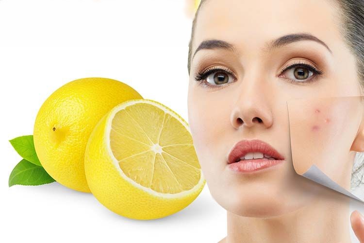 Natural Remedies for Acne Scars